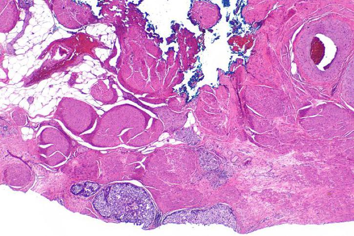 Cáncer de próstata de 7 etapas nueva york